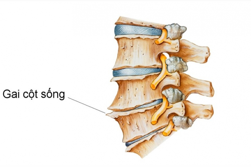 Chữa gai cột sống